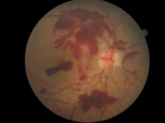 Diabetic Retinopathy Eye Disease
